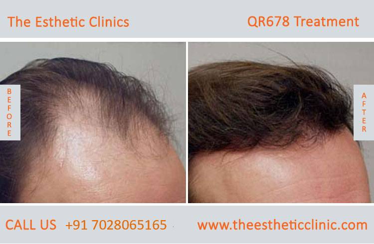 qr678 treatment, qr678 hair injection injection before after photos in mumbai india (6)